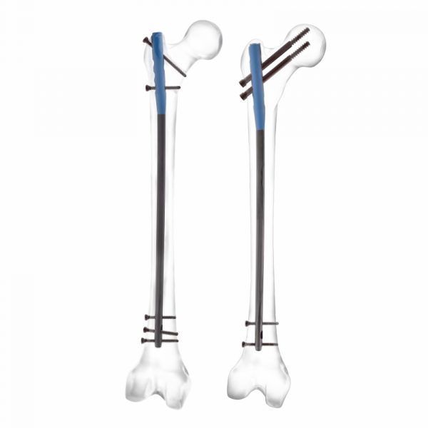 Expert Femoral Nailing System